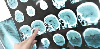 A healthcare professional pointing at brain scan images showing signs of a stroke