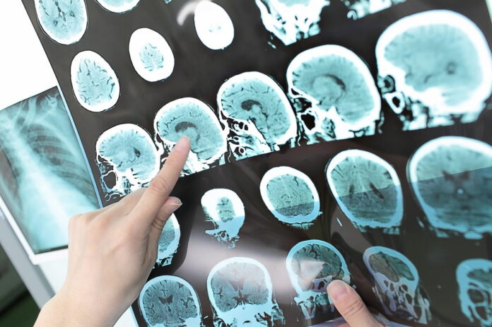 Strokect A healthcare professional pointing at brain scan images showing signs of a stroke